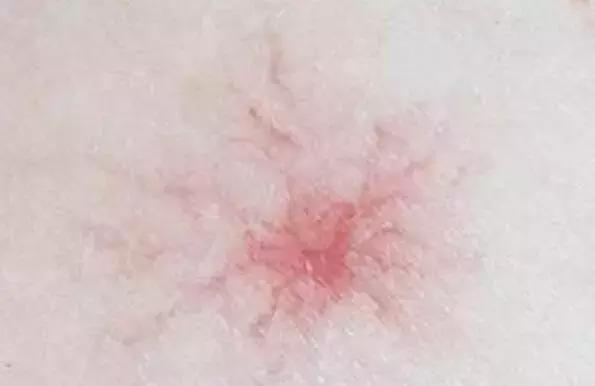 身上长小红痣是什么病的前兆,身上越长越多小红痣什么原因