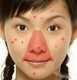 面部有一个危险三角区，这儿的“痘痘”千万不要挤压
