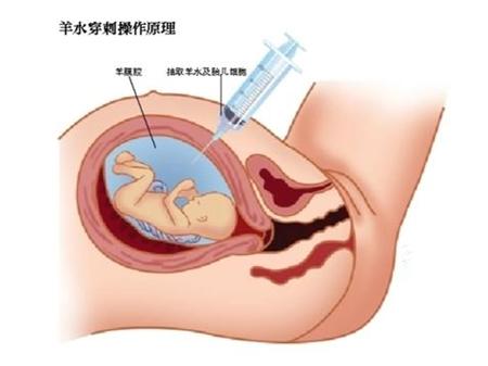 羊水不够的宝宝是不是不怎么动,羊水不够的宝宝