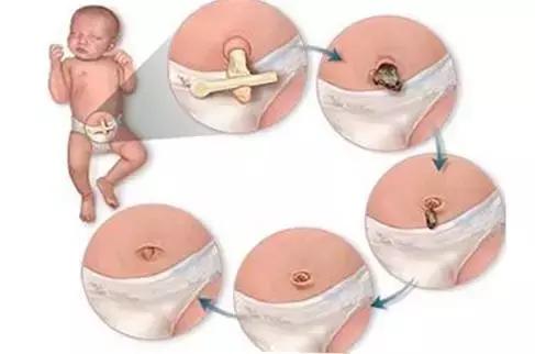 为什么不能抠肚脐眼的黑泥,肚脐眼有什么奥秘为什么不能抠