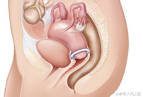 尿闭如何自行处理,尿闭处理措施