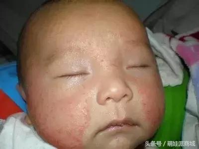 湿疹跟奶粉过敏的区别,湿疹和奶粉有关系吗