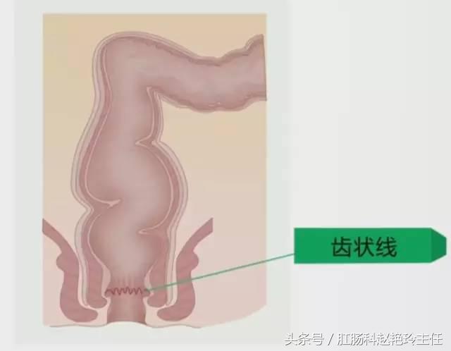 肛瘘是怎么回事？肛瘘是由什么原因造成的