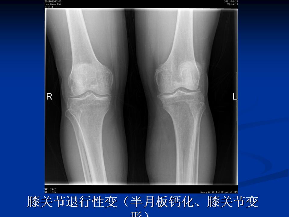 膝关节骨性关节炎的阶梯治疗课件,膝关节炎的非手术疗法