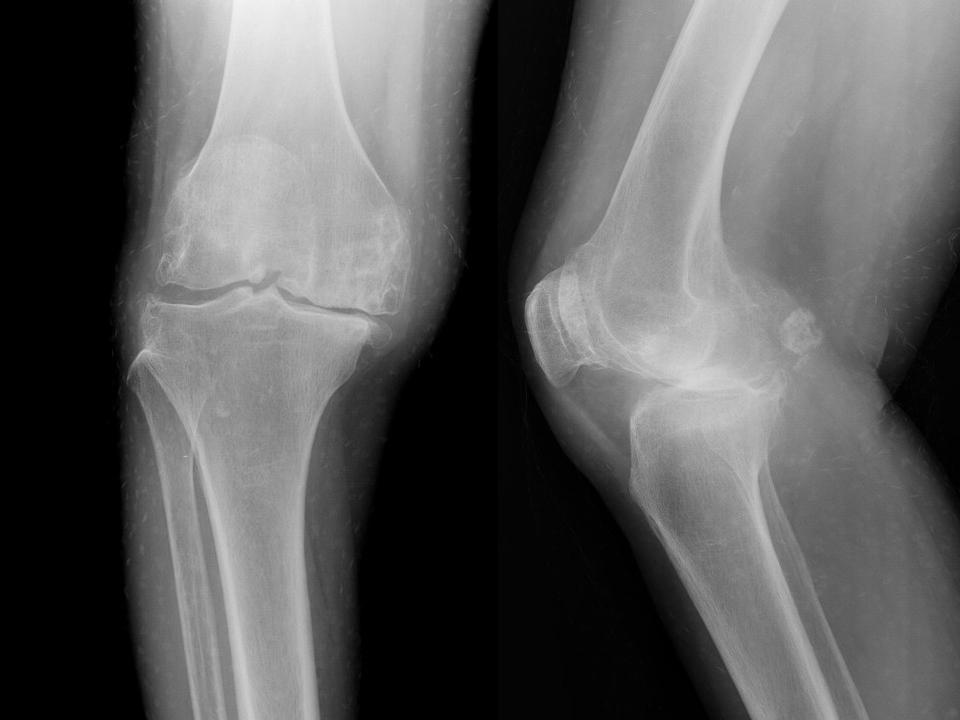 膝关节骨性关节炎的阶梯治疗课件,膝关节炎的非手术疗法