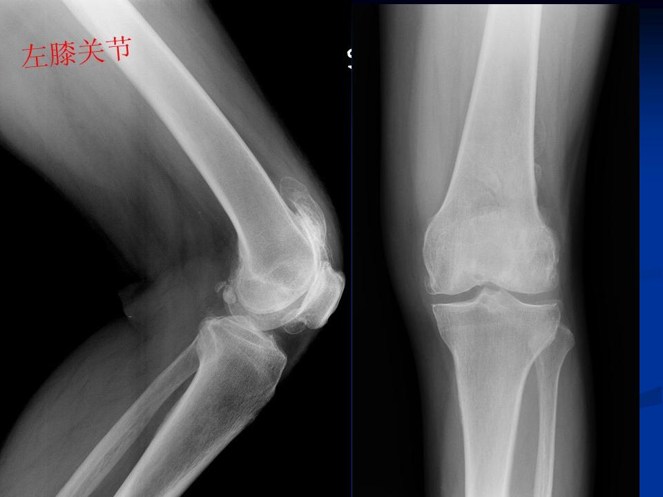 膝关节骨性关节炎的阶梯治疗课件,膝关节炎的非手术疗法