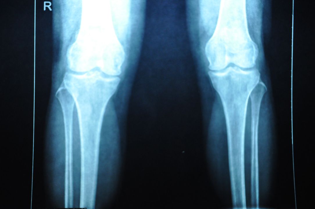 膝关节炎临床治疗讲座,膝骨关节炎中医诊疗指南解读