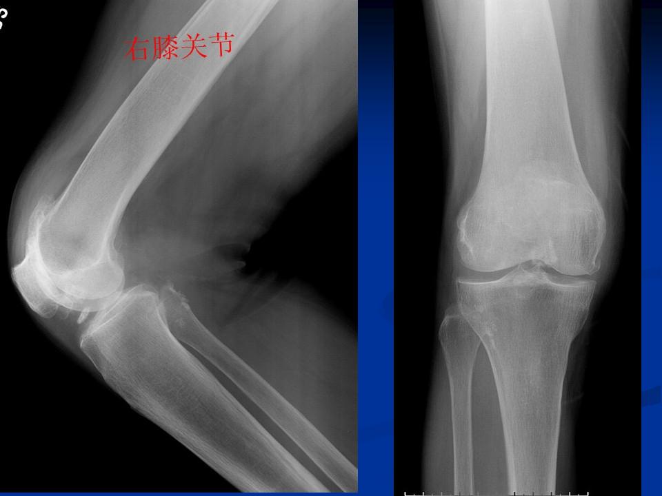 膝关节骨性关节炎的阶梯治疗课件,膝关节炎的非手术疗法