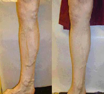 预防静脉曲张，避免久坐久站！可选中医“内服+外敷”治疗