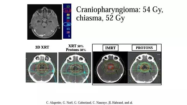 演讲PPT/法国居里研究所皮埃尔贝：儿童神经肿瘤的质子放疗