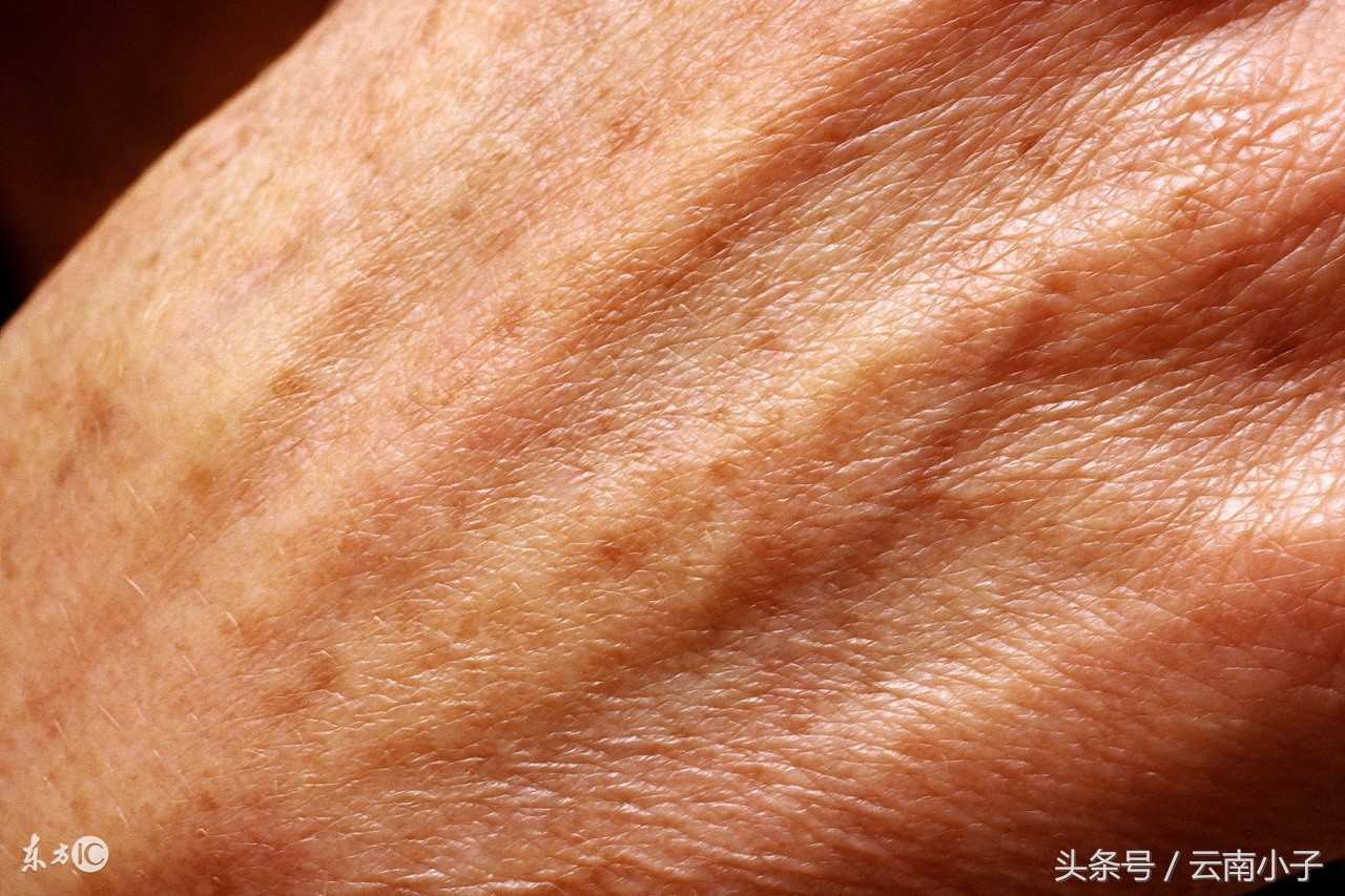 我吃三七粉，主要降低三高，怎么脸上的雀斑全没了！