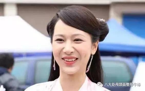 鼻唇沟打玻尿酸有点鼓,什么原因导致鼻唇沟加深