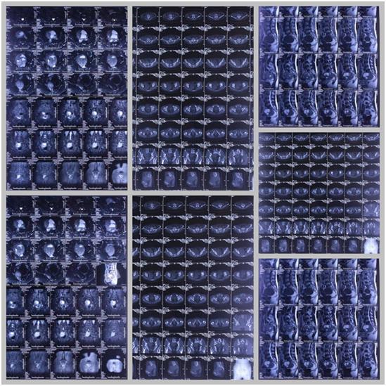 骶骨神经源性肿瘤是什么,骶管囊肿与神经源性肿瘤鉴别