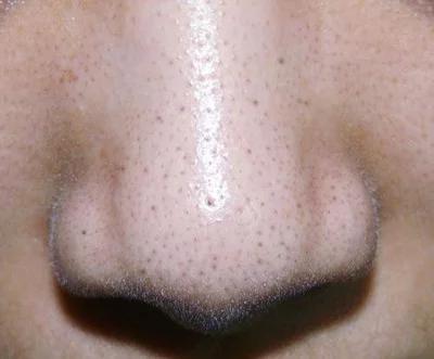 “草莓鼻”的三大特征，我们该如何去除？