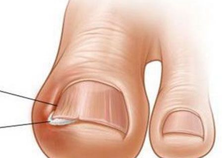 指甲往肉里长该怎么办？一定要试试这几招！