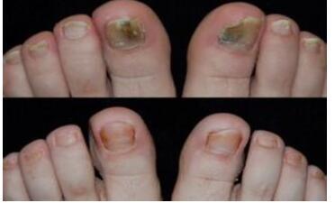 治疗灰指甲被骗一万多,治疗灰指甲的亲身经历