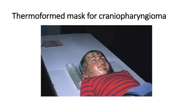 演讲PPT/法国居里研究所皮埃尔贝：儿童神经肿瘤的质子放疗