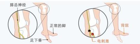 小儿足下垂该怎么治疗