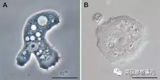 女孩戴隐形眼镜一个月未取失明,眼睛里取出来三十几片隐形眼镜