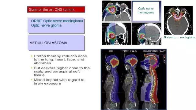 演讲PPT/法国居里研究所皮埃尔贝：儿童神经肿瘤的质子放疗