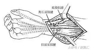 正中神经损伤康复训练,正中神经损伤手指麻痛怎么办
