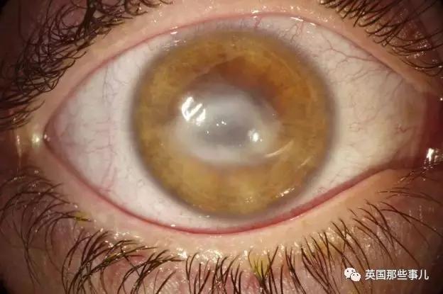 女孩戴隐形眼镜一个月未取失明,眼睛里取出来三十几片隐形眼镜