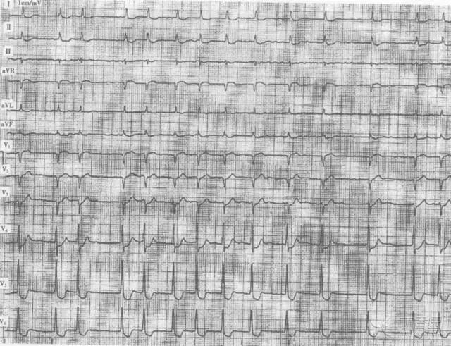 抗心律失常最好的中成药,兼有二三类抗心律失常效果的药物