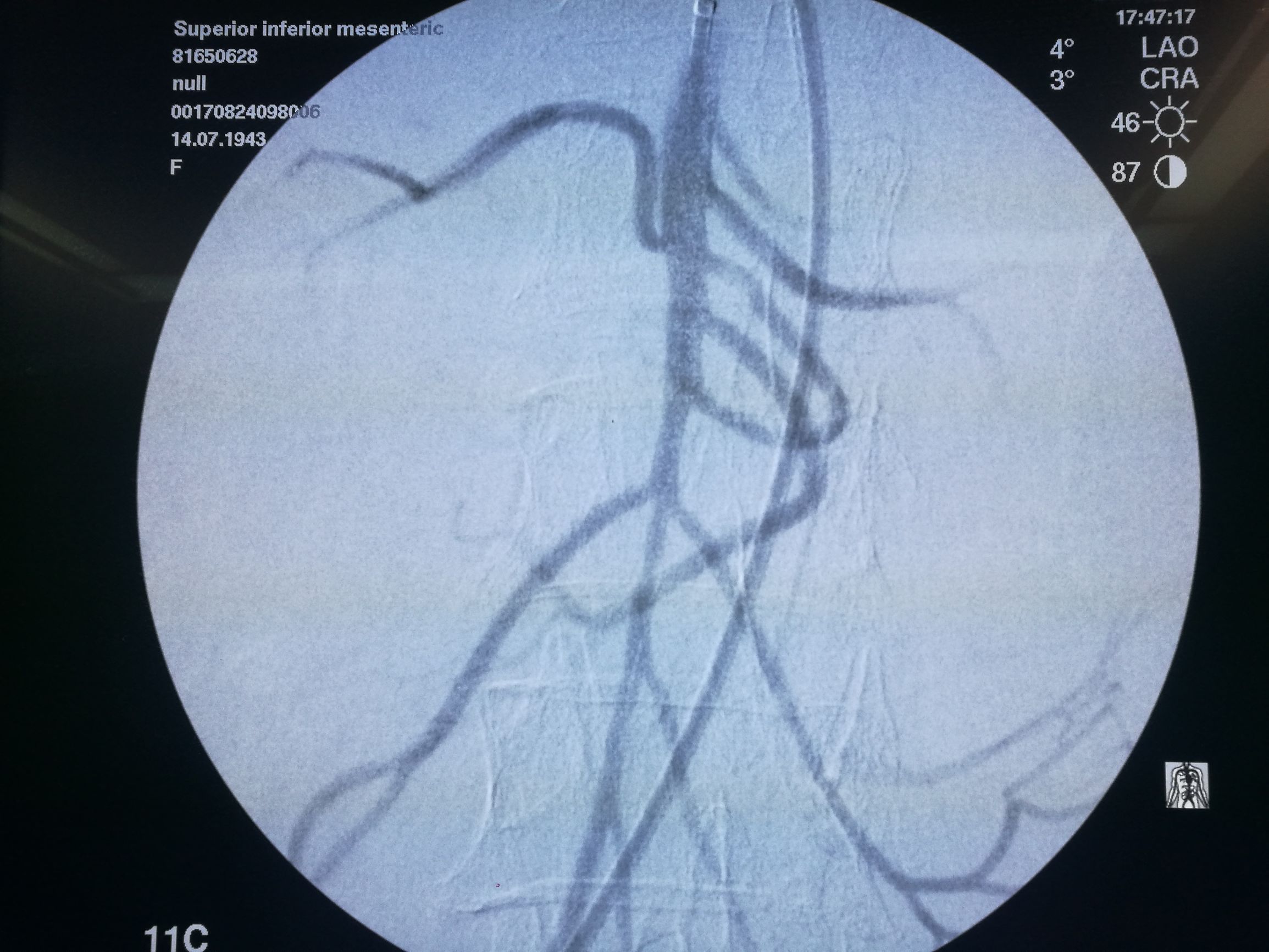 要命的肠缺血被轻松化解