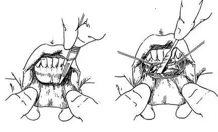 了解下丰胸的含义是什么,隆下巴科普