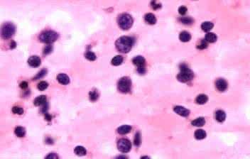 过敏性紫癜是用中医还是西医,过敏性紫癜西医治好还是中医治好