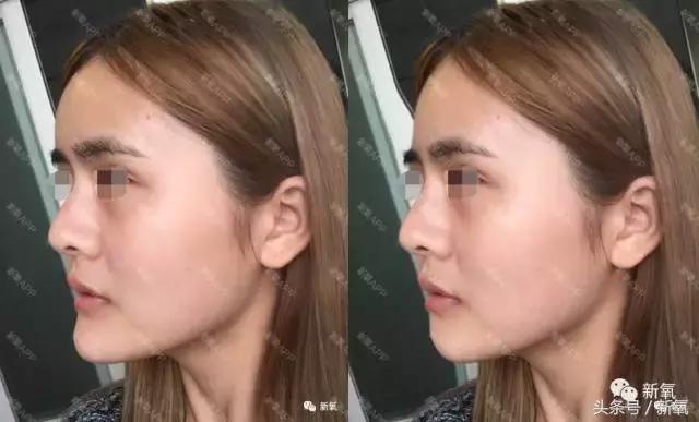 杨紫瘦了腿显得不纤细,杨紫变美之路脸怎么瘦的