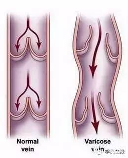 腿上长了这种包千万别瞎挤，小心猝死找上你！