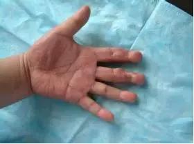 宝宝手指夹伤怎么处理,宝宝手指压伤肿痛怎么处理