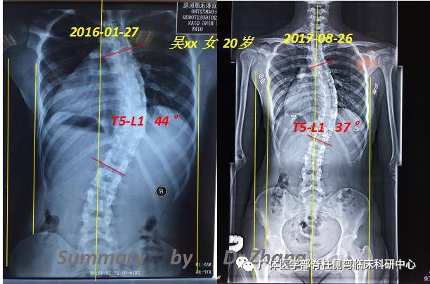 特发性脊柱侧弯成人,青少年特发性脊柱侧弯用什么支架