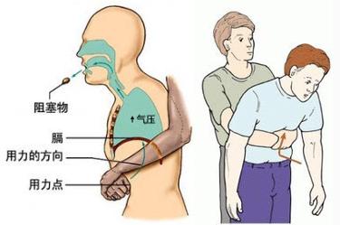 小孩误吞食物卡住喉咙急救,小孩吃东西卡住了海姆立克急救法