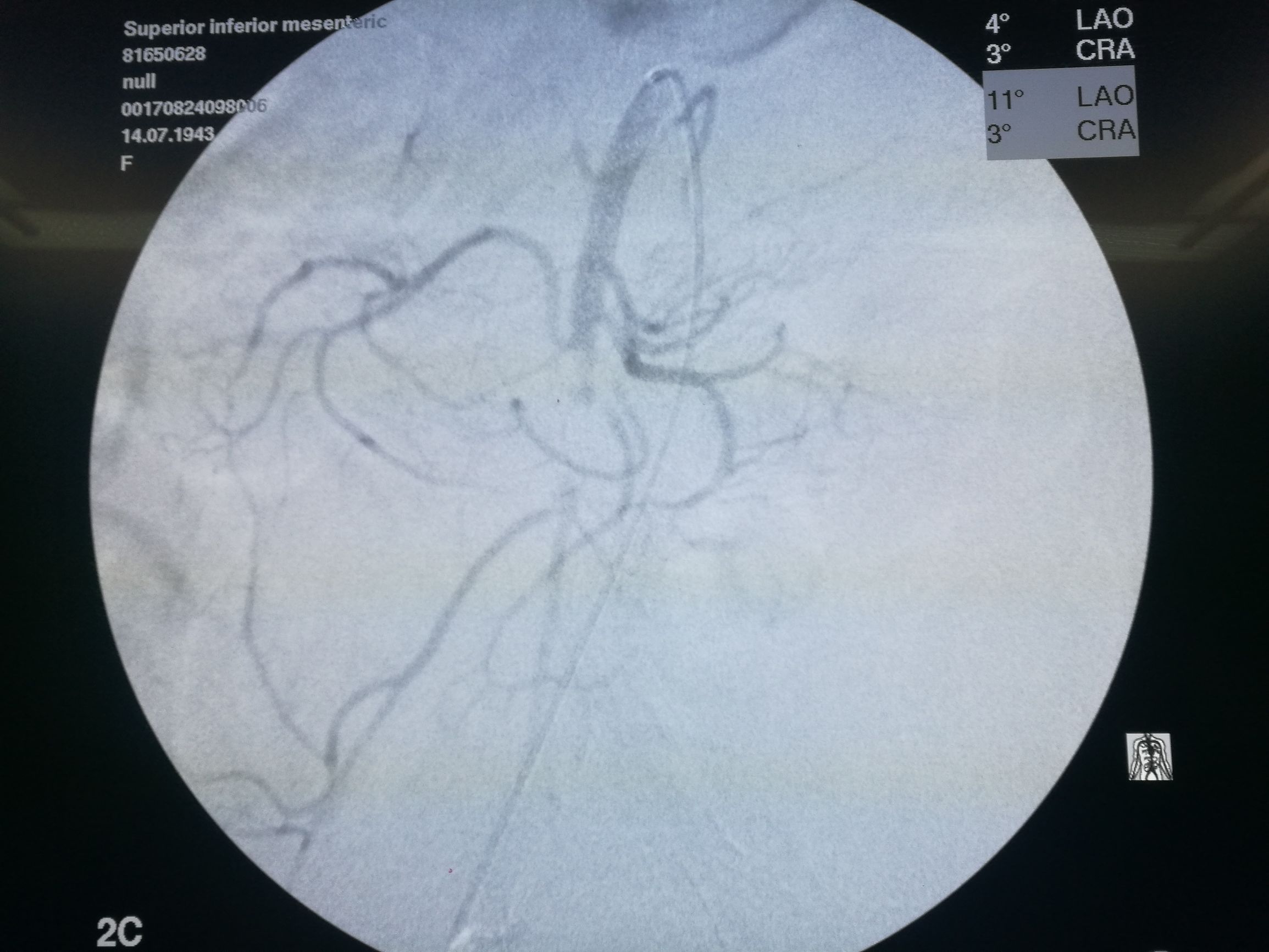 要命的肠缺血被轻松化解