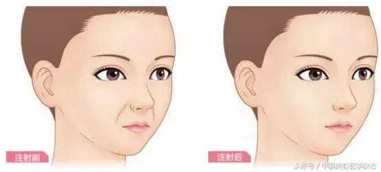 玻尿酸注射后静脉栓塞怎么办,打玻尿酸血管栓塞多久出现