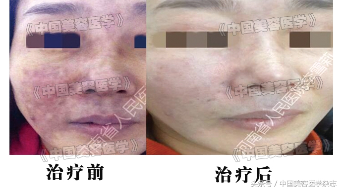 玻尿酸注射后静脉栓塞怎么办,打玻尿酸血管栓塞多久出现