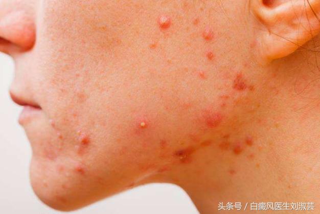 白癜风皮肤病有什么忌口,皮炎湿疹引起的白斑和白癜风区别