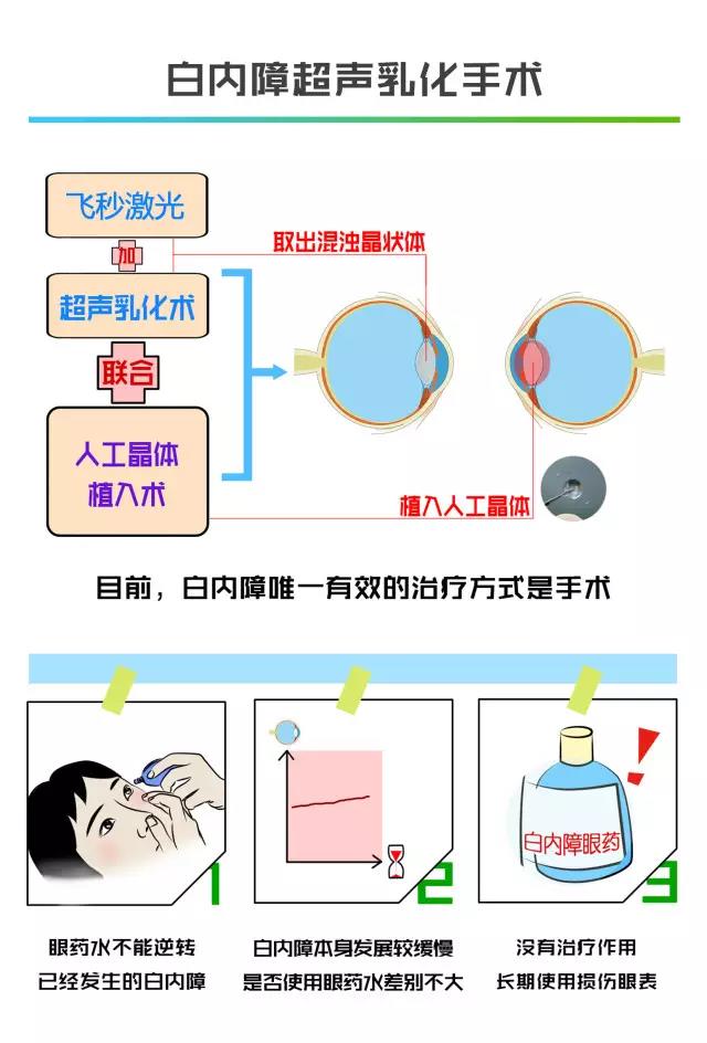 〖周二银海爱眼课堂〗飞秒激光加超声乳化，白内障拜拜！