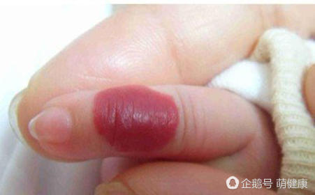 宝贝脸上红肿,宝宝脸上红斑疹子怎么办