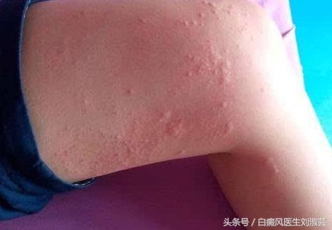 白癜风皮肤病有什么忌口,皮炎湿疹引起的白斑和白癜风区别