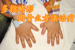 多指畸形最佳治疗方法,严重多指畸形最佳治疗方案是什么