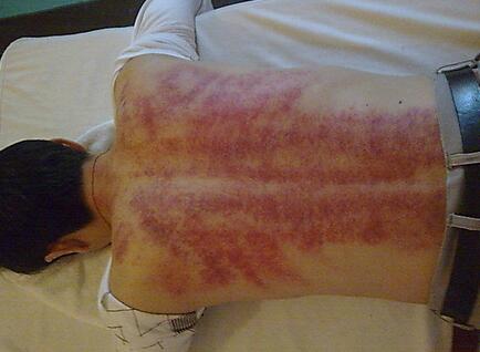 刮痧棒刮痧的正确方法,面部刮痧正确的刮痧步骤