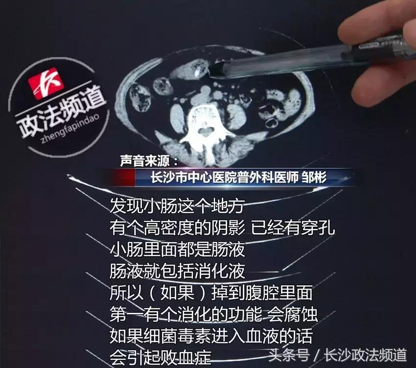 72岁老人误吞枣核后遗症,误吞枣核到小肠