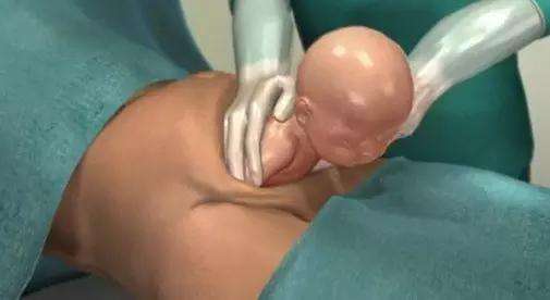 可以自由选择顺产和剖腹产吗,顺产选择无痛分娩好吗