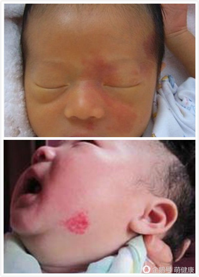 宝贝脸上红肿,宝宝脸上红斑疹子怎么办