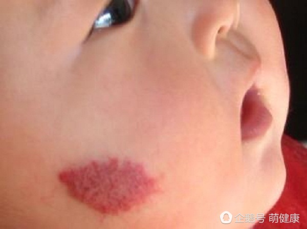 宝贝脸上红肿,宝宝脸上红斑疹子怎么办