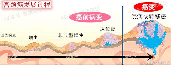 宫颈癌癌前病变cin3有什么症状,宫颈癌前病变cin3级要切子宫吗
