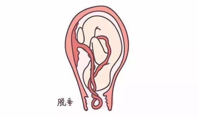 可以自由选择顺产和剖腹产吗,顺产选择无痛分娩好吗